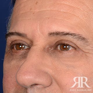 Eyelid Surgery Before & After Gallery - Patient 357162 - Image 4