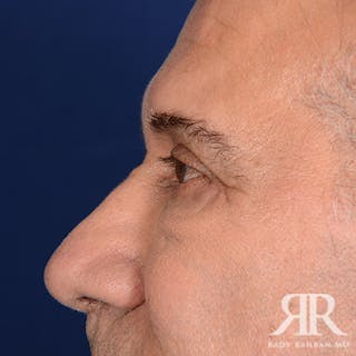 Eyelid Surgery Before & After Gallery - Patient 357162 - Image 6
