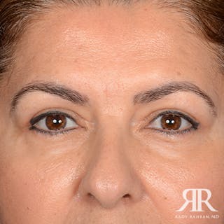 Eyelid Surgery Before & After Gallery - Patient 385278 - Image 2