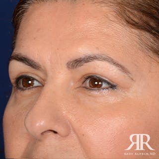 Eyelid Surgery Before & After Gallery - Patient 385278 - Image 4