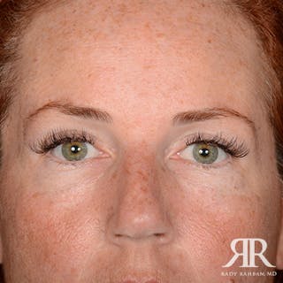 Eyelid Surgery Before & After Gallery - Patient 229018 - Image 2