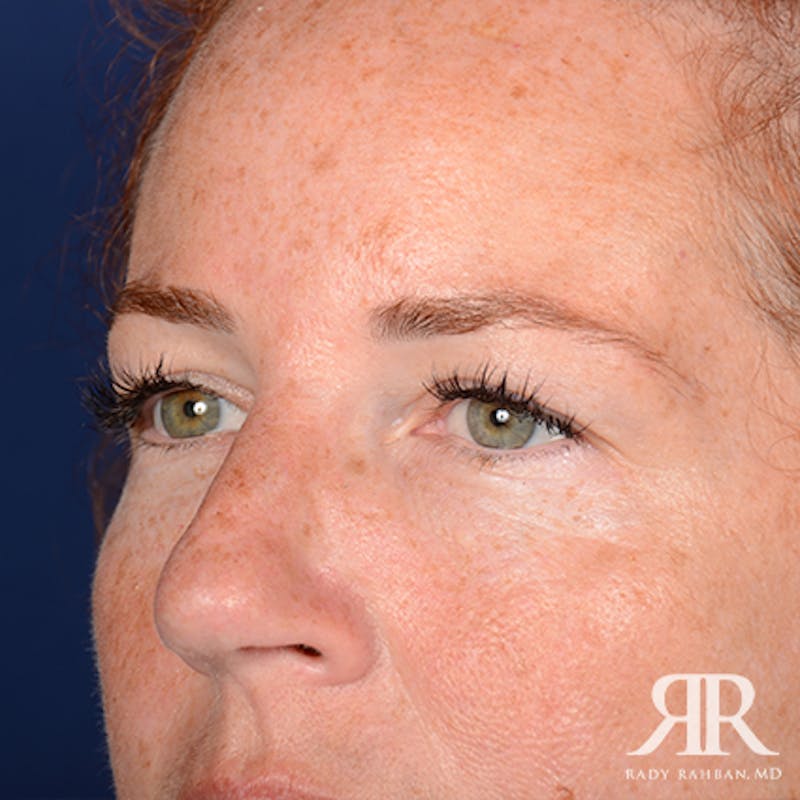 Eyelid Surgery Before & After Gallery - Patient 229018 - Image 3