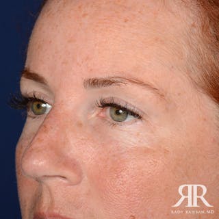 Eyelid Surgery Before & After Gallery - Patient 229018 - Image 4
