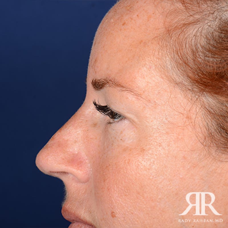 Eyelid Surgery Before & After Gallery - Patient 229018 - Image 5