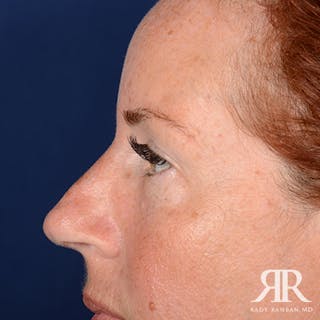 Eyelid Surgery Before & After Gallery - Patient 229018 - Image 6