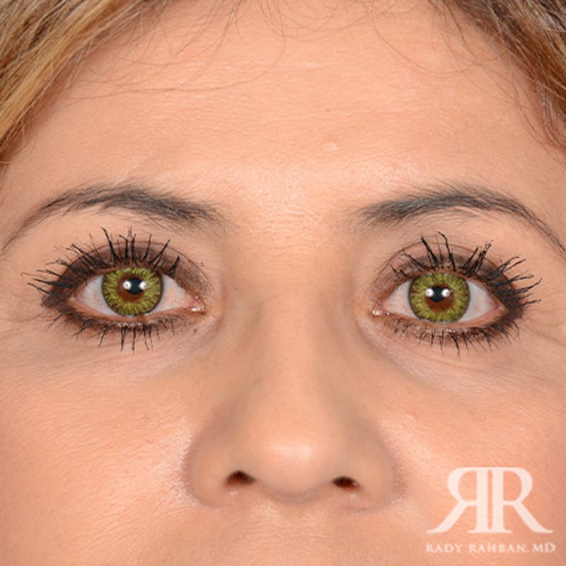 Eyelid Surgery Before & After Gallery - Patient 324605 - Image 2