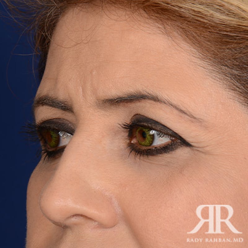 Eyelid Surgery Before & After Gallery - Patient 324605 - Image 3