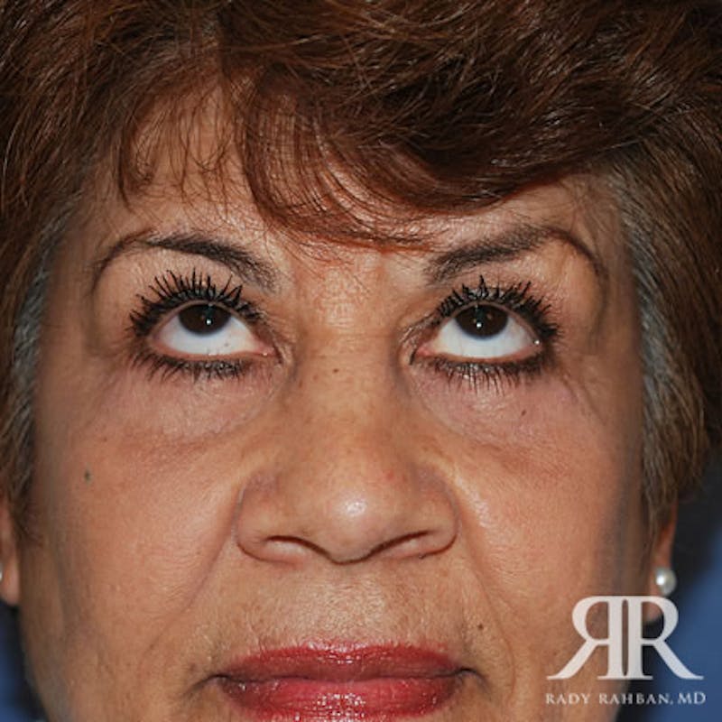 Eyelid Surgery Before & After Gallery - Patient 479551 - Image 4