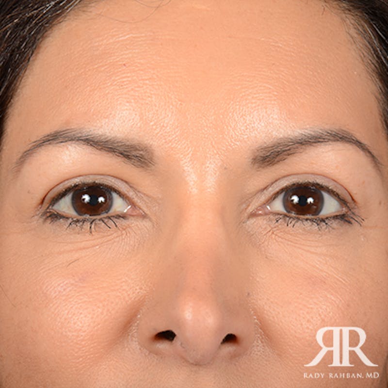 Eyelid Surgery Before & After Gallery - Patient 257652 - Image 2