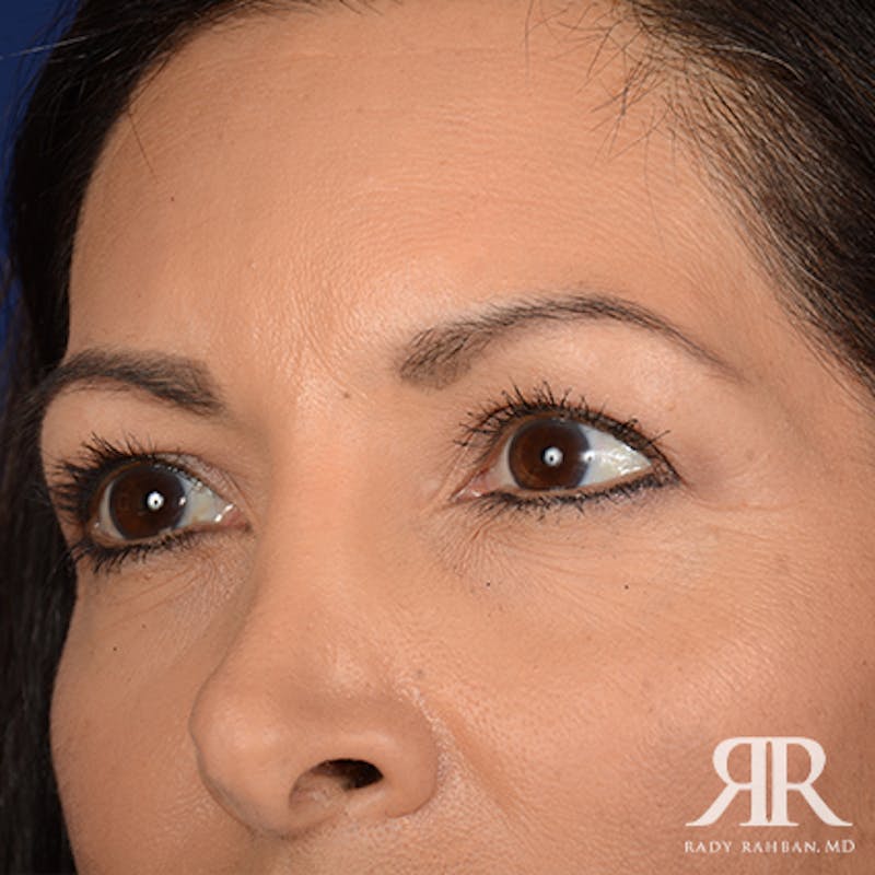 Eyelid Surgery Before & After Gallery - Patient 257652 - Image 3
