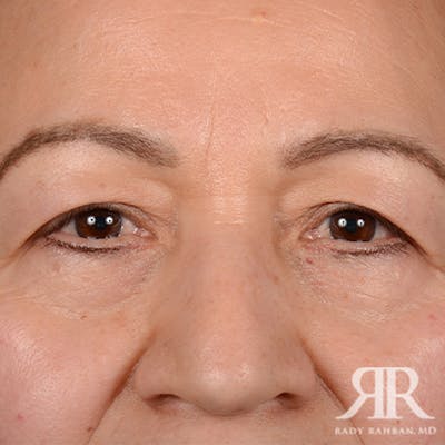 Eyelid Surgery Before & After Gallery - Patient 159006 - Image 1