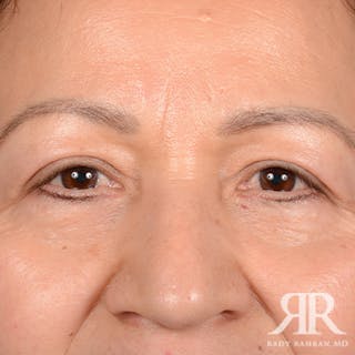 Eyelid Surgery Before & After Gallery - Patient 159006 - Image 2