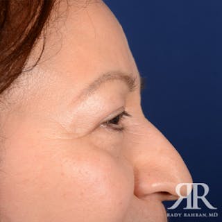 Eyelid Surgery Before & After Gallery - Patient 159006 - Image 6