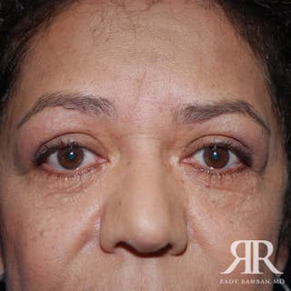 Eyelid Surgery Before & After Gallery - Patient 276488 - Image 2