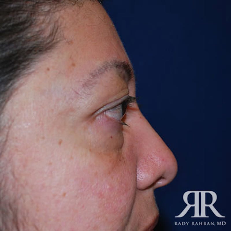 Eyelid Surgery Before & After Gallery - Patient 773446 - Image 3