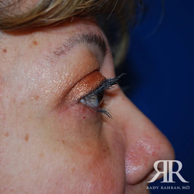 Eyelid Surgery Before & After Gallery - Patient 773446 - Image 4