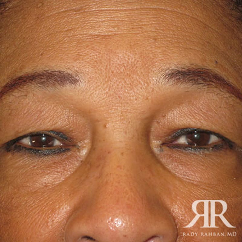 Eyelid Surgery Before & After Gallery - Patient 725405 - Image 1