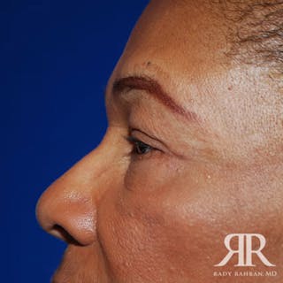 Eyelid Surgery Before & After Gallery - Patient 725405 - Image 4