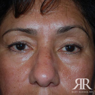 Eyelid Surgery Before & After Gallery - Patient 862799 - Image 1