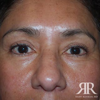Eyelid Surgery Before & After Gallery - Patient 862799 - Image 2