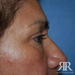 Eyelid Surgery Before & After Gallery - Patient 862799 - Image 4