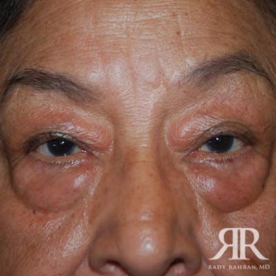 Eyelid Surgery Before & After Gallery - Patient 164427 - Image 1