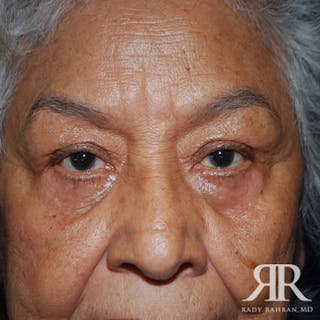 Eyelid Surgery Before & After Gallery - Patient 164427 - Image 2