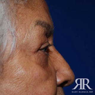 Eyelid Surgery Before & After Gallery - Patient 164427 - Image 4