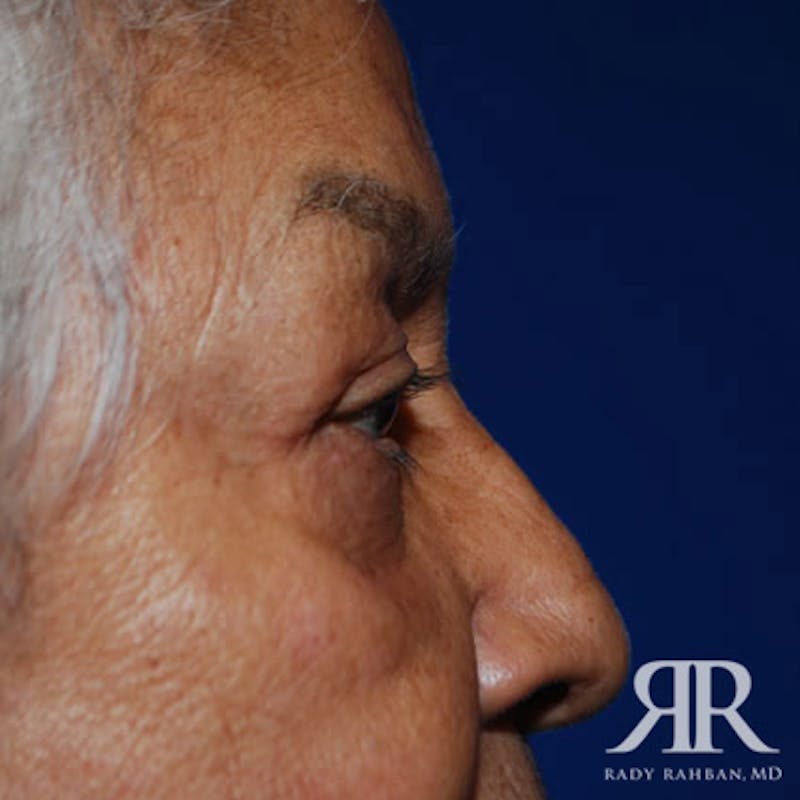 Eyelid Surgery Before & After Gallery - Patient 164427 - Image 4