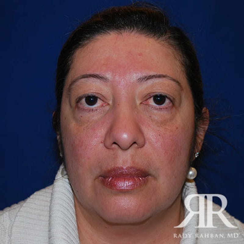 Browlift Before & After Gallery - Patient 854838 - Image 1