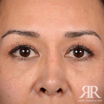 Eyelid Surgery Before & After Gallery - Patient 140195 - Image 1