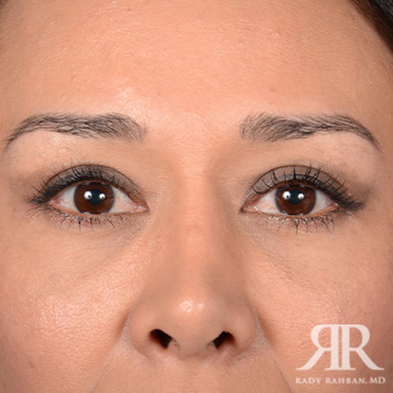 Eyelid Surgery Before & After Gallery - Patient 140195 - Image 2