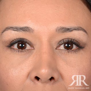 Eyelid Surgery Before & After Gallery - Patient 140195 - Image 2