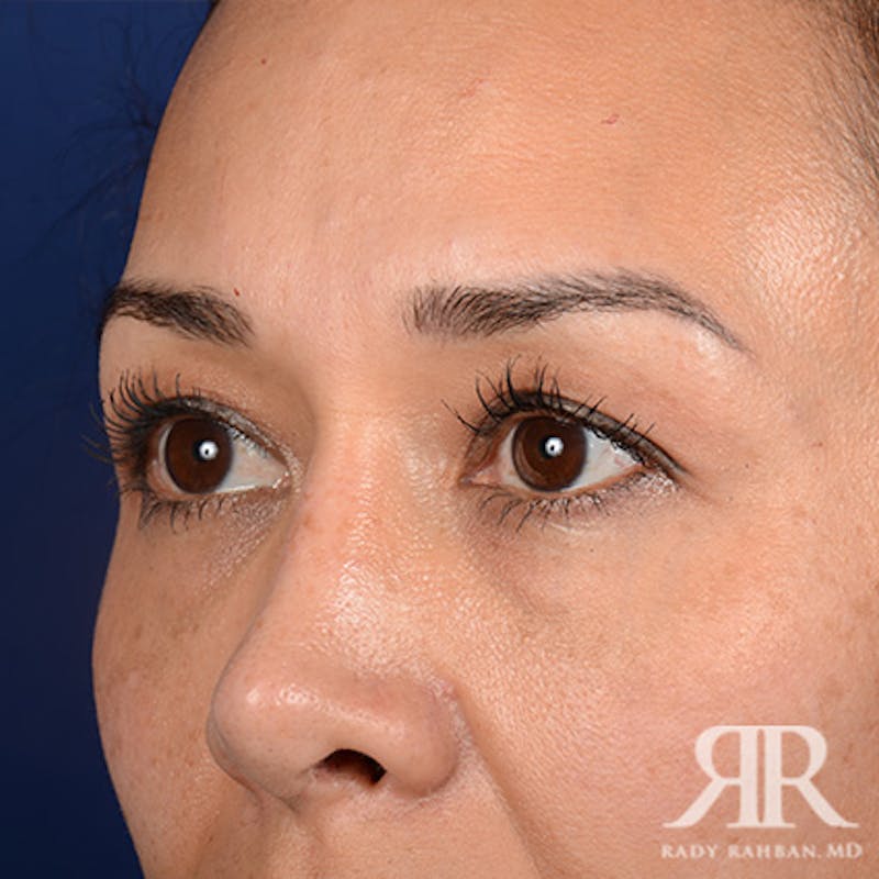 Eyelid Surgery Before & After Gallery - Patient 140195 - Image 3