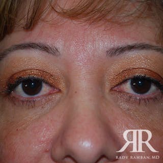 Browlift Before & After Gallery - Patient 854838 - Image 4