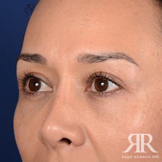 Eyelid Surgery Before & After Gallery - Patient 140195 - Image 4