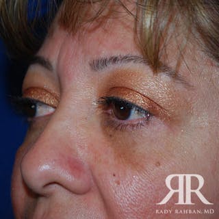 Browlift Before & After Gallery - Patient 854838 - Image 6