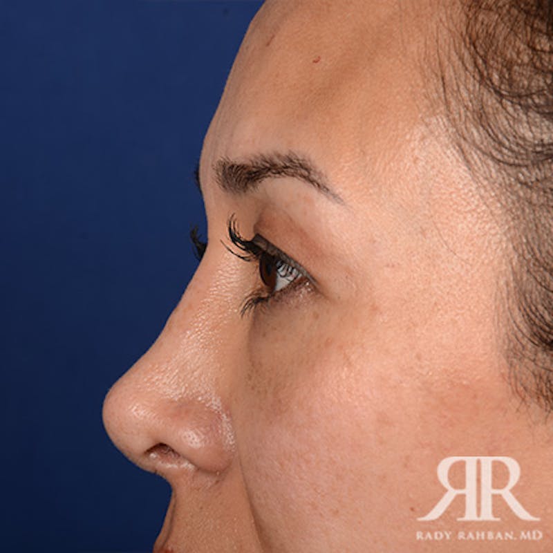 Eyelid Surgery Before & After Gallery - Patient 140195 - Image 5