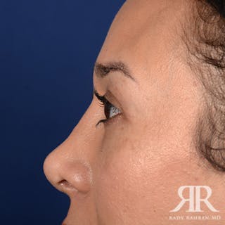 Eyelid Surgery Before & After Gallery - Patient 140195 - Image 6