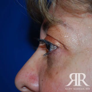 Browlift Before & After Gallery - Patient 854838 - Image 8