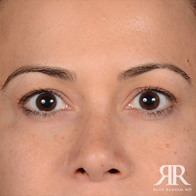 Eyelid Surgery Before & After Gallery - Patient 163128 - Image 1