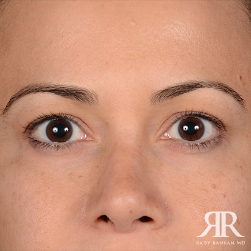 Eyelid Surgery Before & After Gallery - Patient 163128 - Image 1