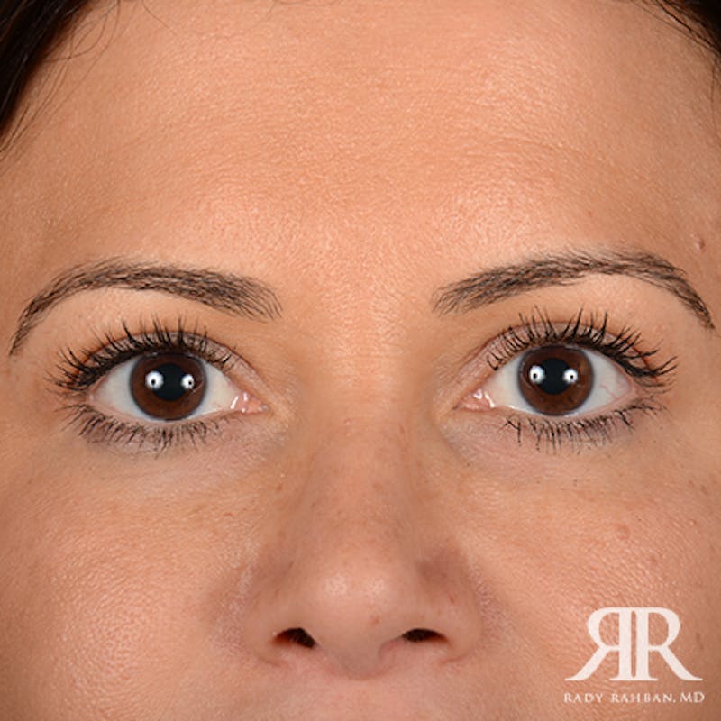 Eyelid Surgery Before & After Gallery - Patient 163128 - Image 2