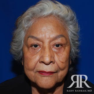 Browlift Before & After Gallery - Patient 876005 - Image 2