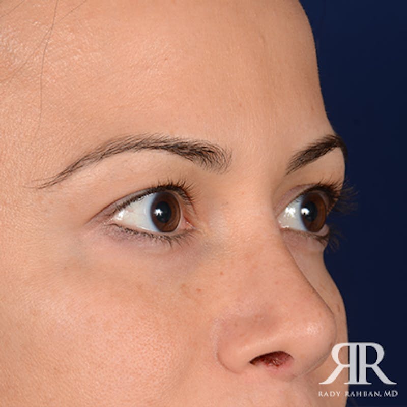 Eyelid Surgery Before & After Gallery - Patient 163128 - Image 3