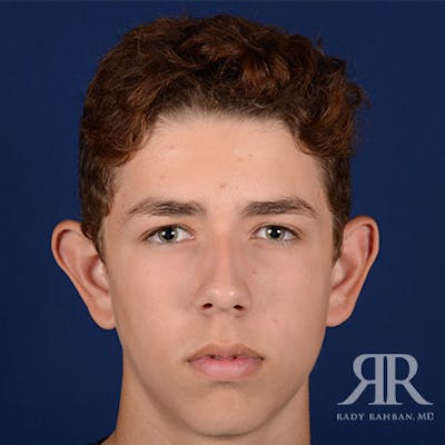 Ear Pinning Surgery Before & After Gallery - Patient 237783 - Image 1