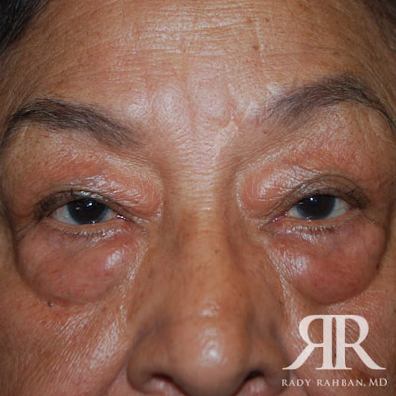 Browlift Before & After Gallery - Patient 876005 - Image 3