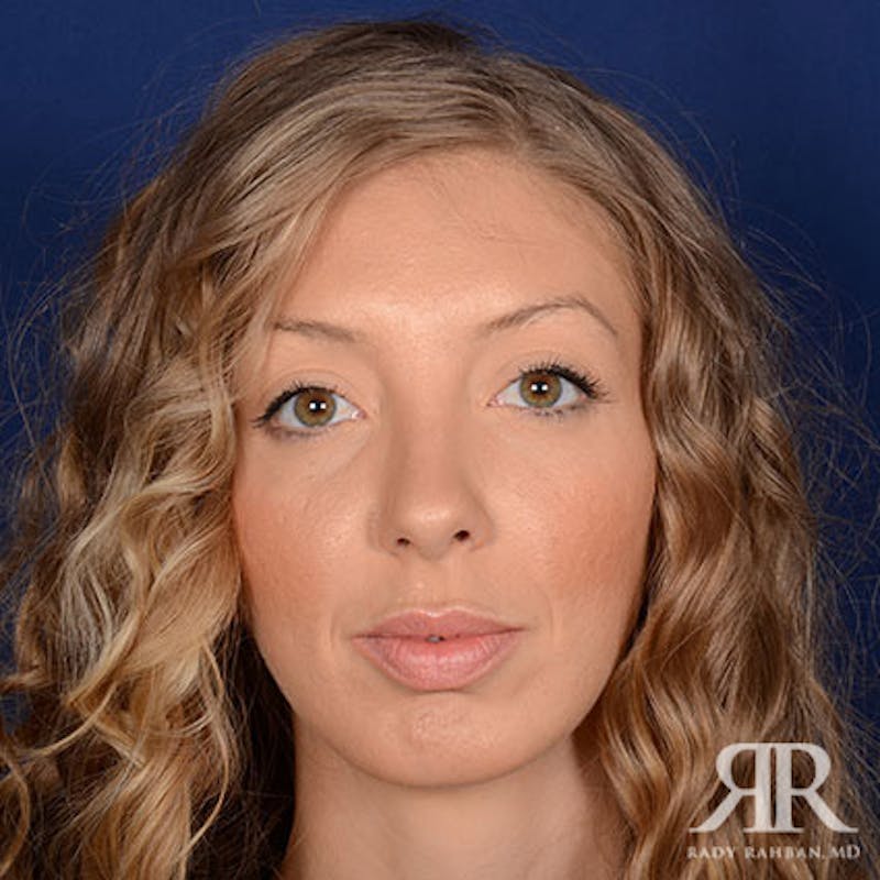 Before and after patient results