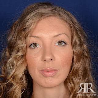 Chin Augmentation Before & After Gallery - Patient 361365 - Image 2