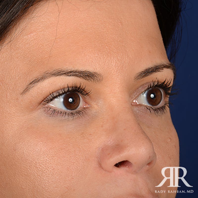 Eyelid Surgery Before & After Gallery - Patient 163128 - Image 4